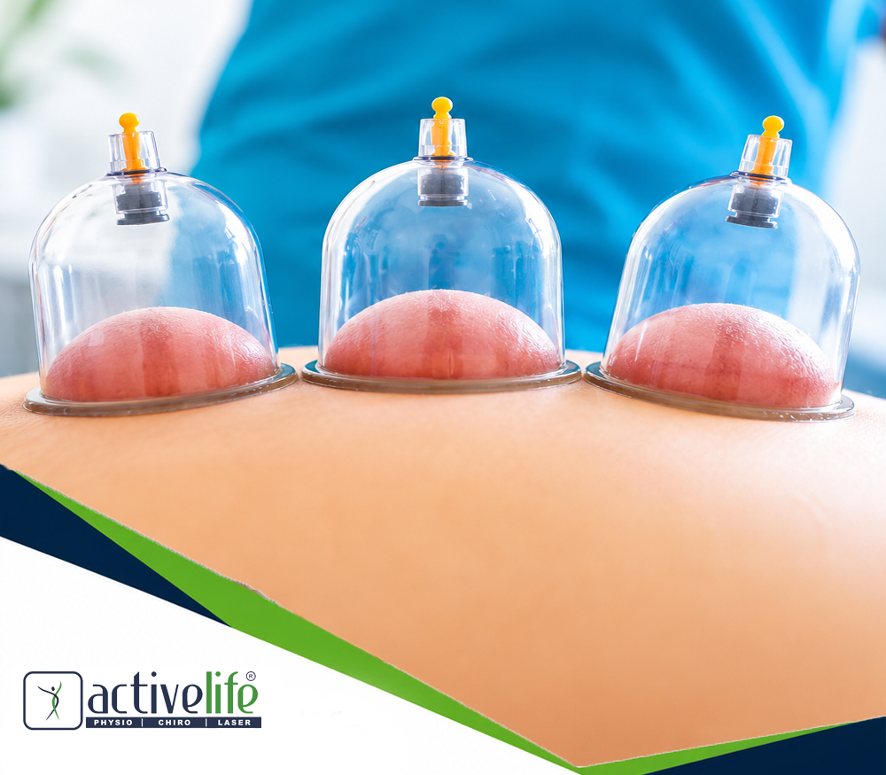 Cupping Therapy