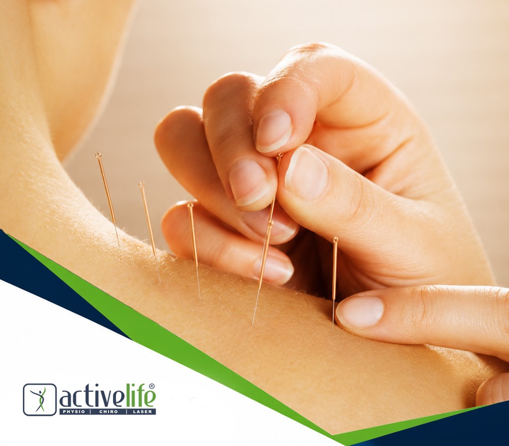 Dry Needling