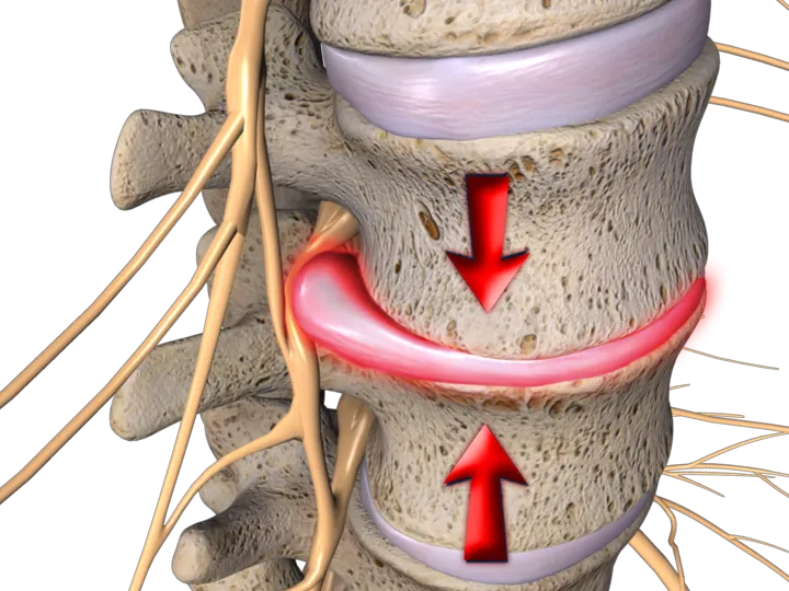 Neck Pain Physiotherapy